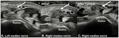 Case report: Traumatic median neuropathy in the distal forearm after massage therapy